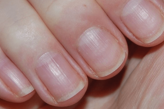 vertical lines on your nails