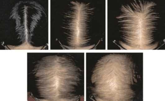 Parietal Hair Loss