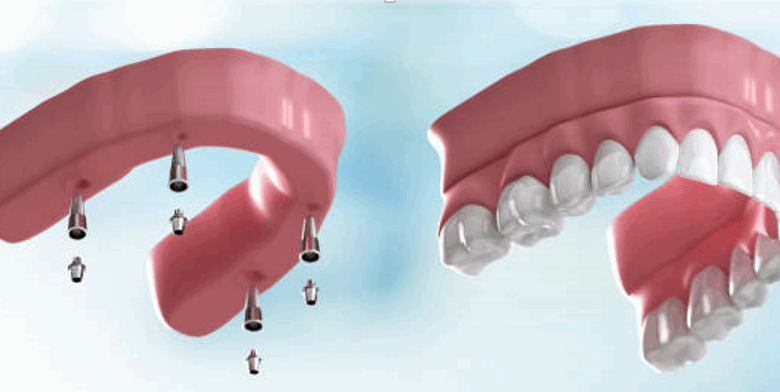 The Science Behind Osseointegration: How Implants Bond to Your Jaw