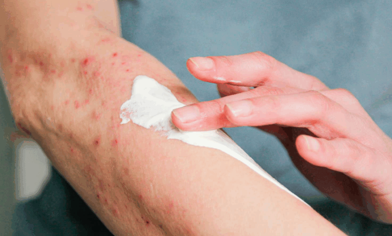 Bed Bug Bite Reactions: From Harmless Irritations to Severe Allergic Responses