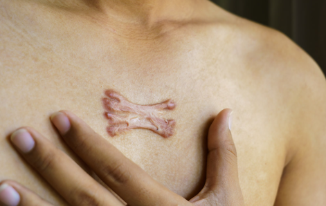 Keloid Scar Treatment: Innovative Approaches to Skin Healing