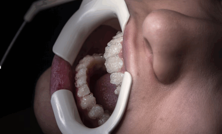 How Invisalign Treatment Boosts Confidence and Oral Health