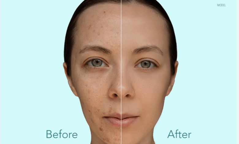 Skin Revival: How Comprehensive Acne Care Delivers Real Results